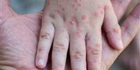 عاجل|
      إصابة
      24
      بالجدري
      المائي..
      إجراء
      جديد
      بشأن
      طلاب
      مدرسة
      الباجور
      بالمنوفية - كورة نيوز