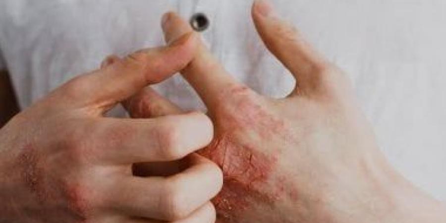 أشهر مشاكل الصيف الجلدية.. إزاى تحمى نفسك - كورة نيوز