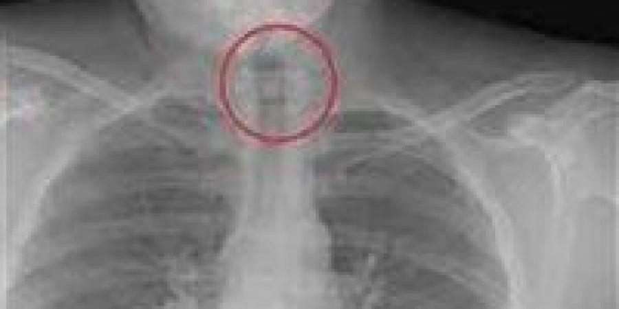 عاجل..
      إنقاذ
      طالبة
      في
      الأقصر
      بعد
      ابتلاع
      دبوس
      أثناء
      ضبط
      الحجاب - كورة نيوز