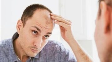 وداعًا لتساقط الشعر.. علاج واعد للصلع باستخدام الخلايا الجذعية